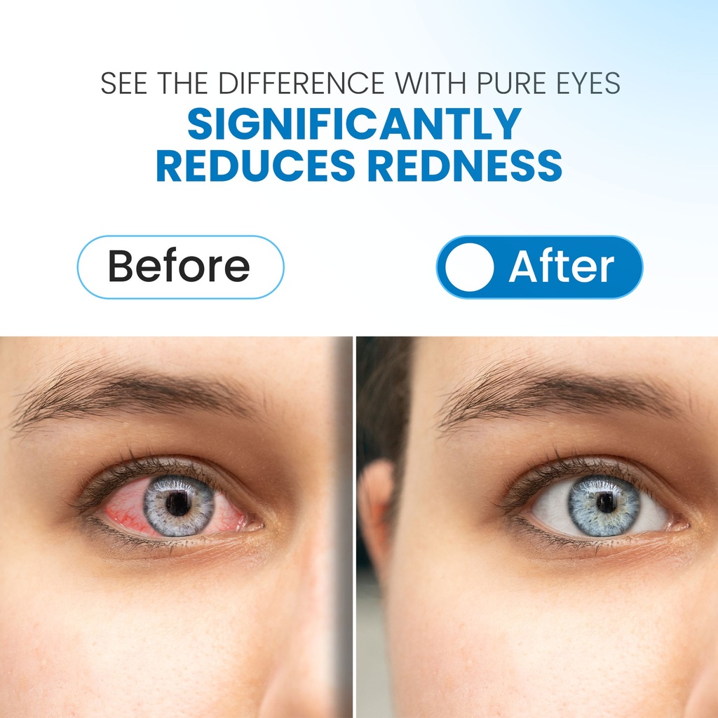 PURE EYES® Sterile Maximum Redness Relief Eye Drops - Pack of 12 (7mL)